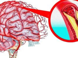Эффективное очищение сосудов головного мозга — 5 уникальных методик